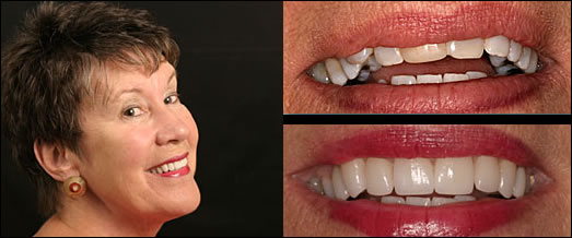 Smile Gallery Before and After Result 3 by Sarasota Dentist - Dr. Jenifer C. Back