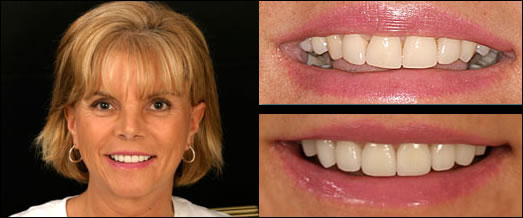 Smile Gallery Before and After Result 1 by Sarasota Dentist - Dr. Jenifer C. Back