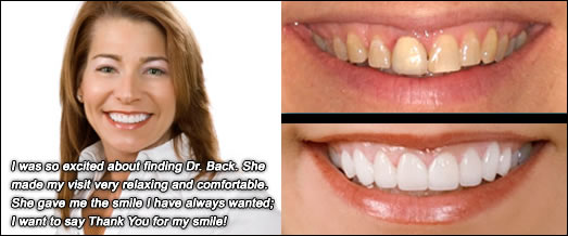Smile Gallery Before and After Result 5 by Sarasota Dentist - Dr. Jenifer C. Back