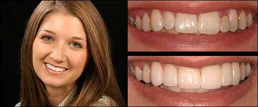 Smile Gallery Before and After Result 4 by Sarasota Dentist - Dr. Jenifer C. Back