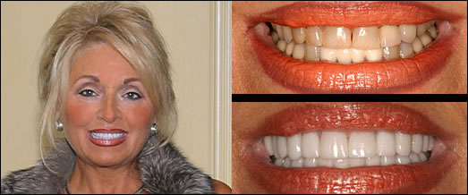 Smile Gallery Before and After Result 2 by Sarasota Dentist - Dr. Jenifer C. Back