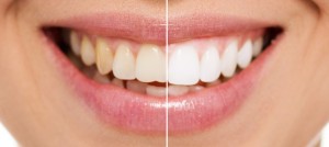 Reasons that Porcelain Veneers Sarasota May be Right for You