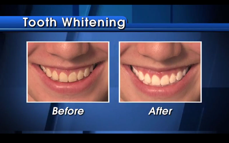 Sarasota Tooth Whitening Specialists