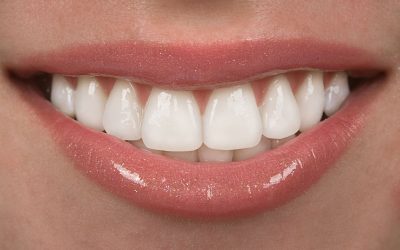 Veneers – How Long Do They Last?