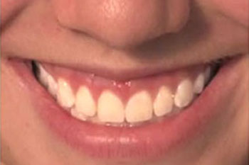 Sarasota Tooth Whitening Specialists