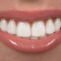 Whitening Your SMILE – The pros and cons of teeth whitening